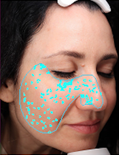 Age 45: Spots