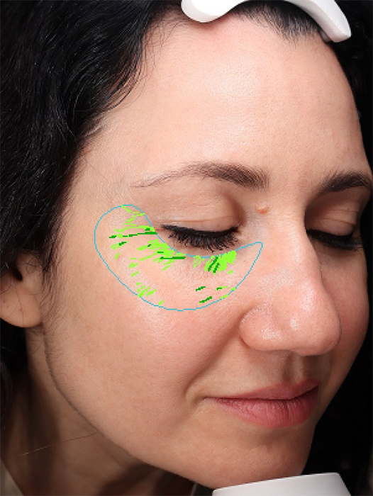 VISIA wrinkle scan after 12 weeks ATIKA 2025