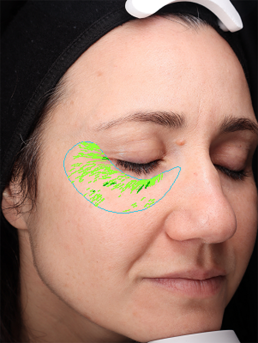 VISIA facial scan showing wrinkle analysis at age 43, baseline percentile 81%. Green overlay highlights wrinkle depth around the eye area prior to using ATIKA Advanced Skin Nutrition, a clinically backed skin longevity supplement.