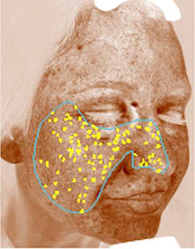 Age 45: Brown Spots